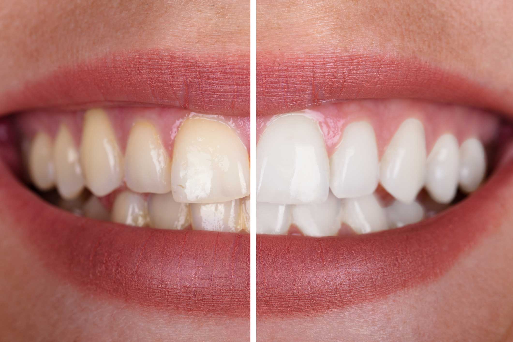 blanqueamiento-dental clínica dental en Santander, dentista en Santander, estética dental en Santander