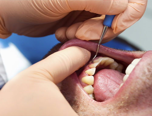 ¿En qué consiste un alargamiento coronario y cuándo recurrimos a ello?