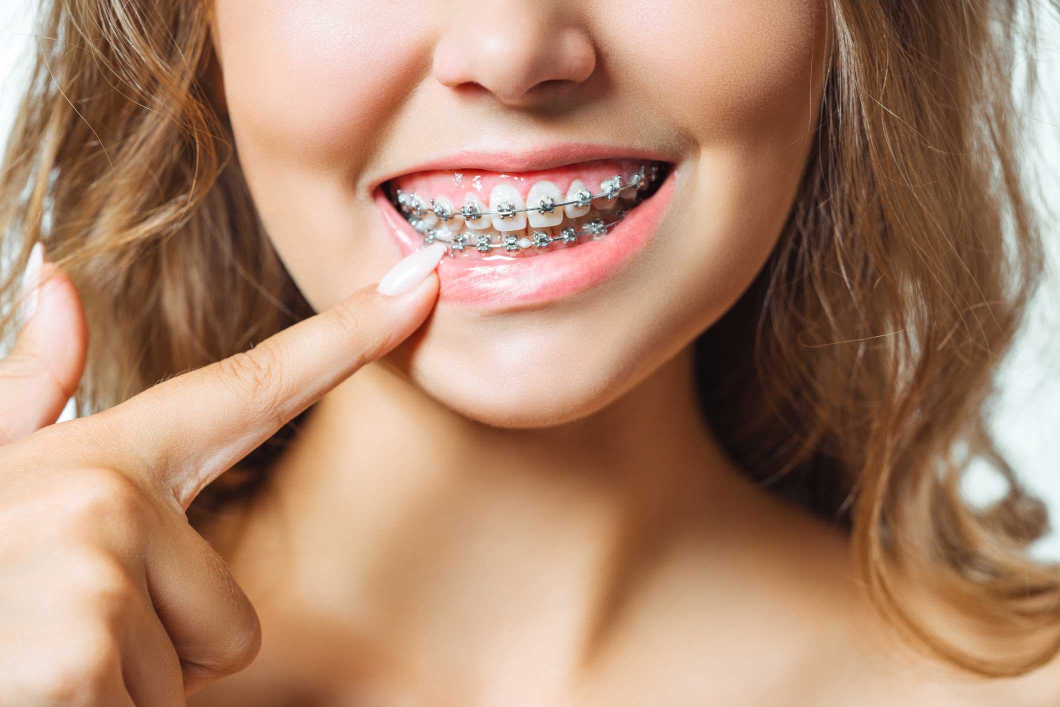 brackets-metalicos ortodoncia en Santander, invisalign en Santander