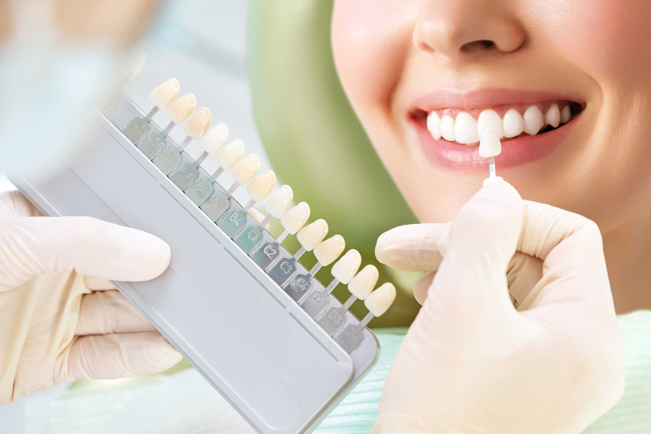 carillas-dentales clínica dental en Santander, dentista en Santander, estética dental en Santander