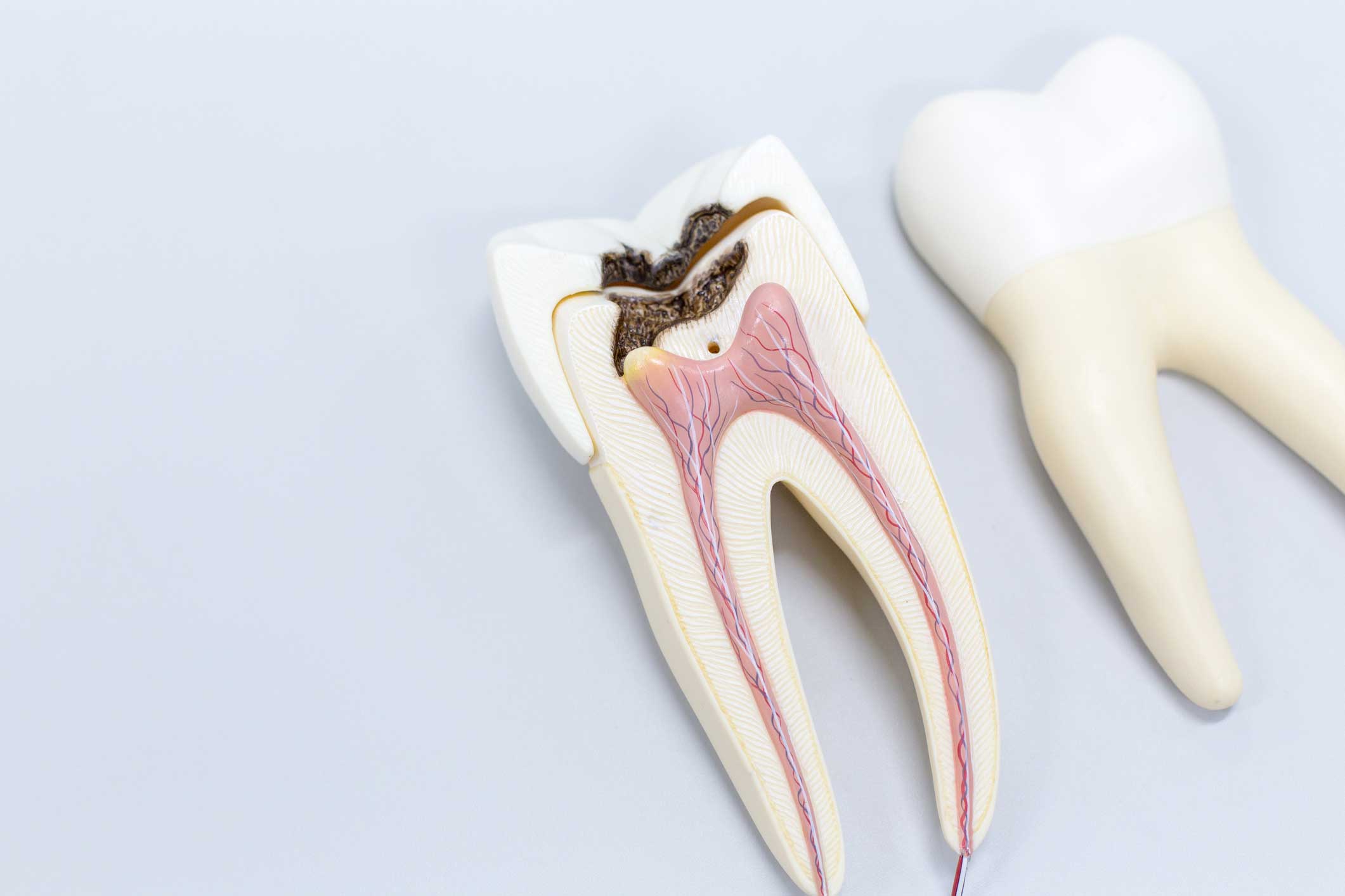 endodoncia-modelo endodoncia en Santander, endodoncista en Santander