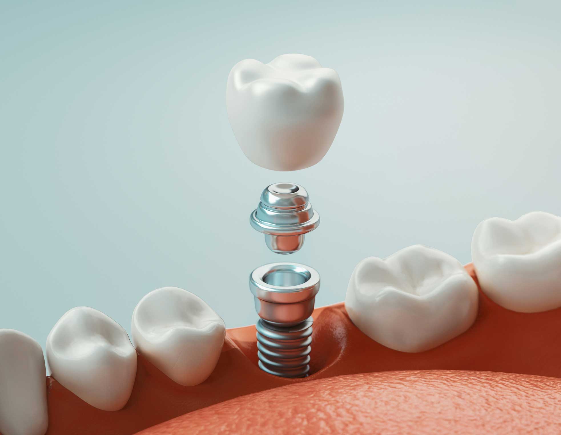 implantologia-carga-inmediata clínica dental en Santander, dentista en Santander, implantología en Santander