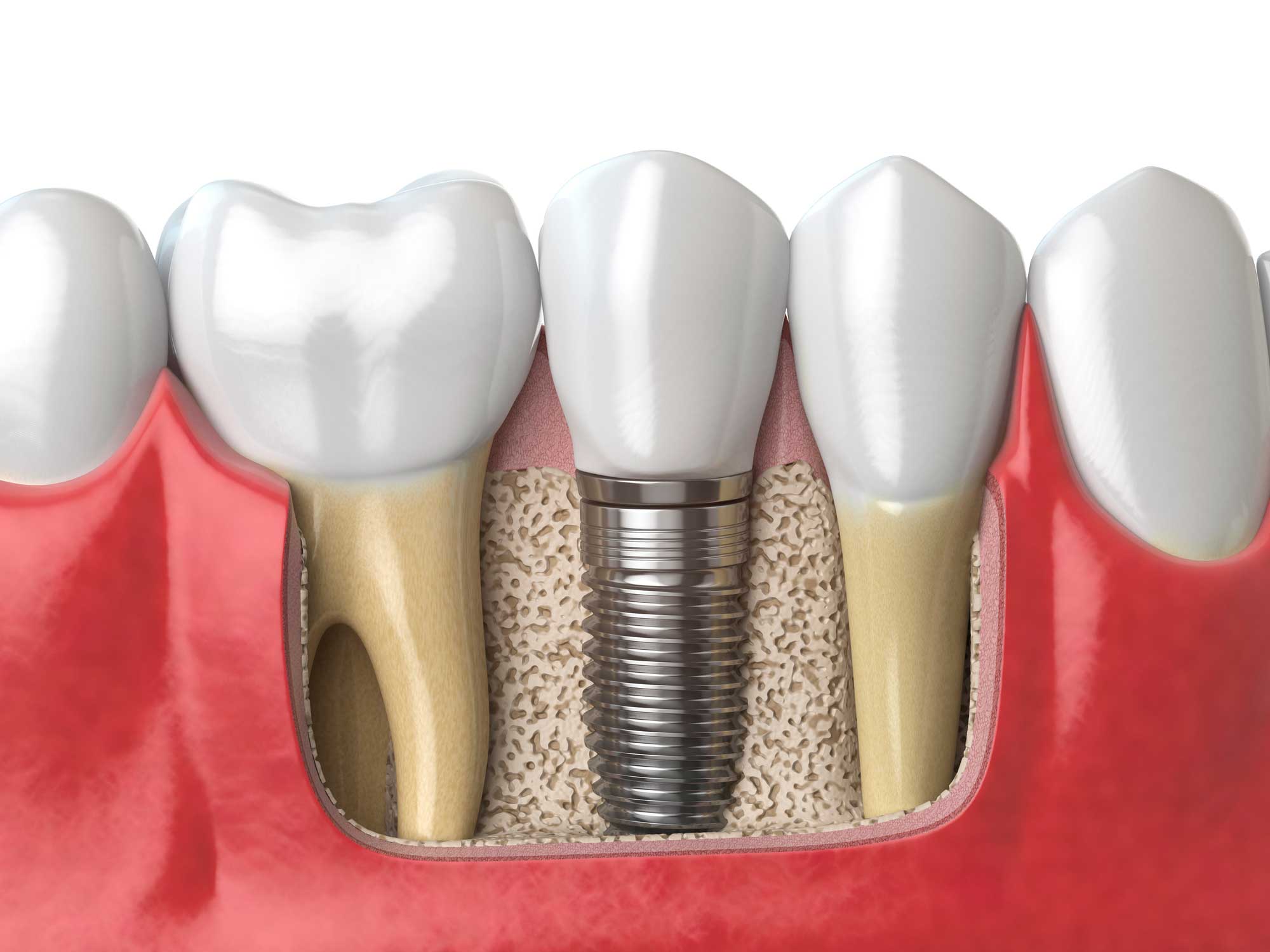 implantologia-colocacion clínica dental en Santander, dentista en Santander, implantología en Santander