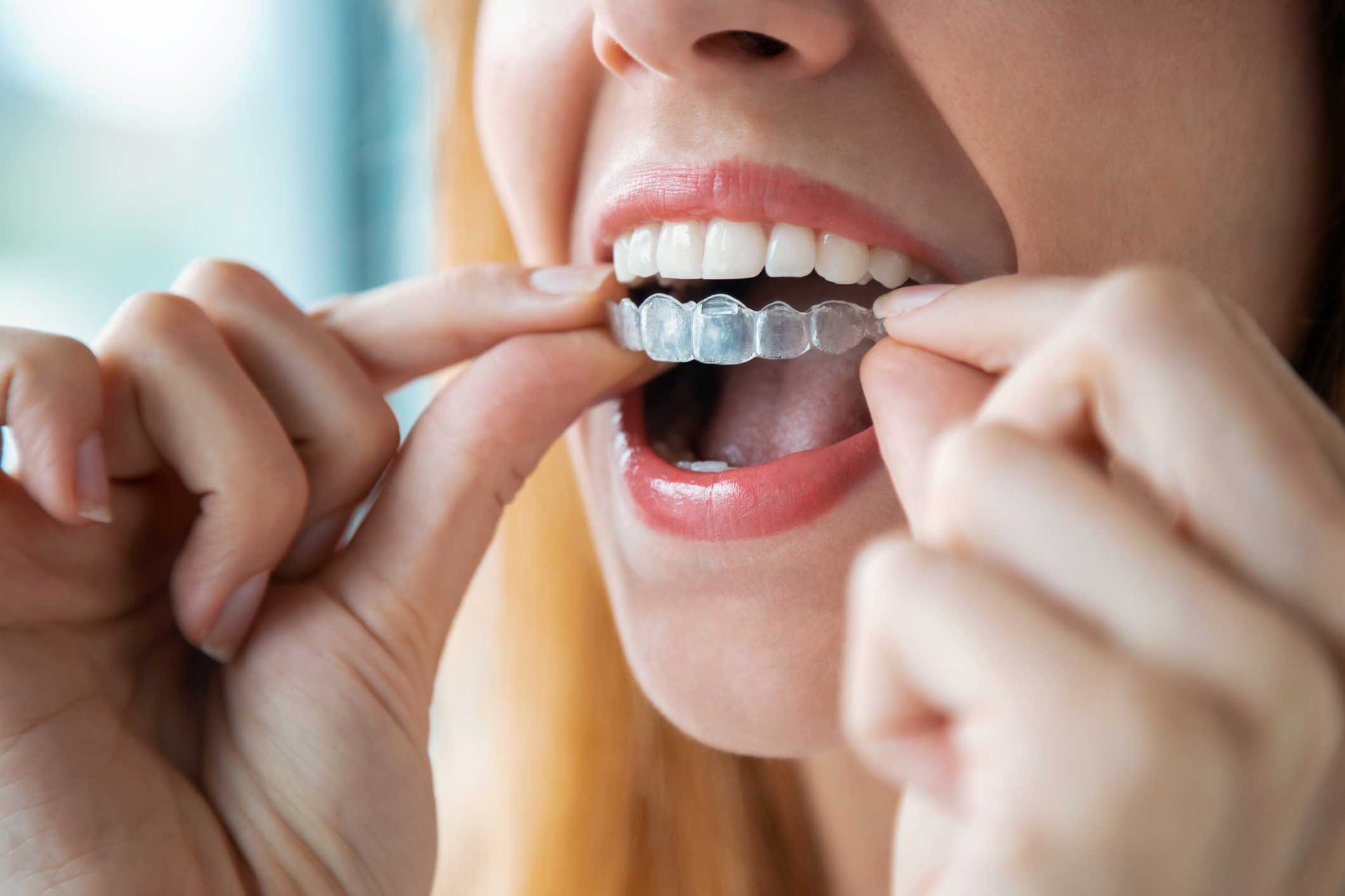 ortodoncia-invisible ortodoncia en Santander, invisalign en Santander