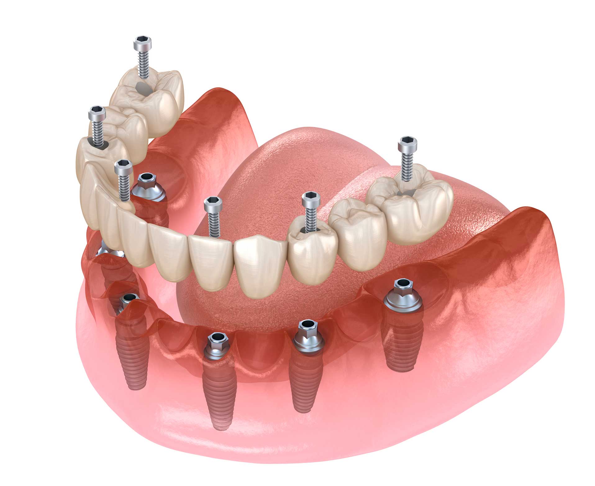 protesis-fija prótesis dentales en Santander, prostodoncia en Santander